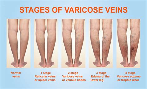 6 clase de vene varicoase
